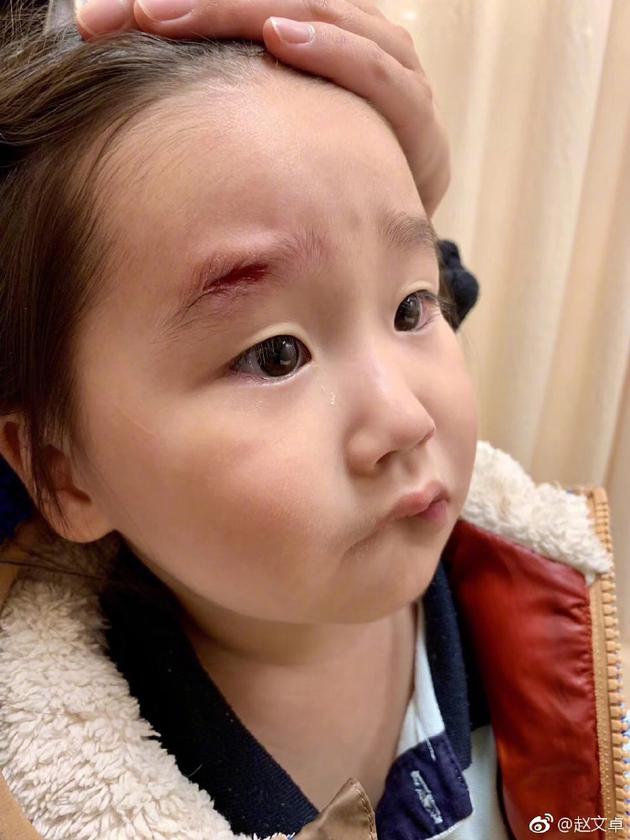 女儿脸部受伤缝七针 赵文卓直喊心疼